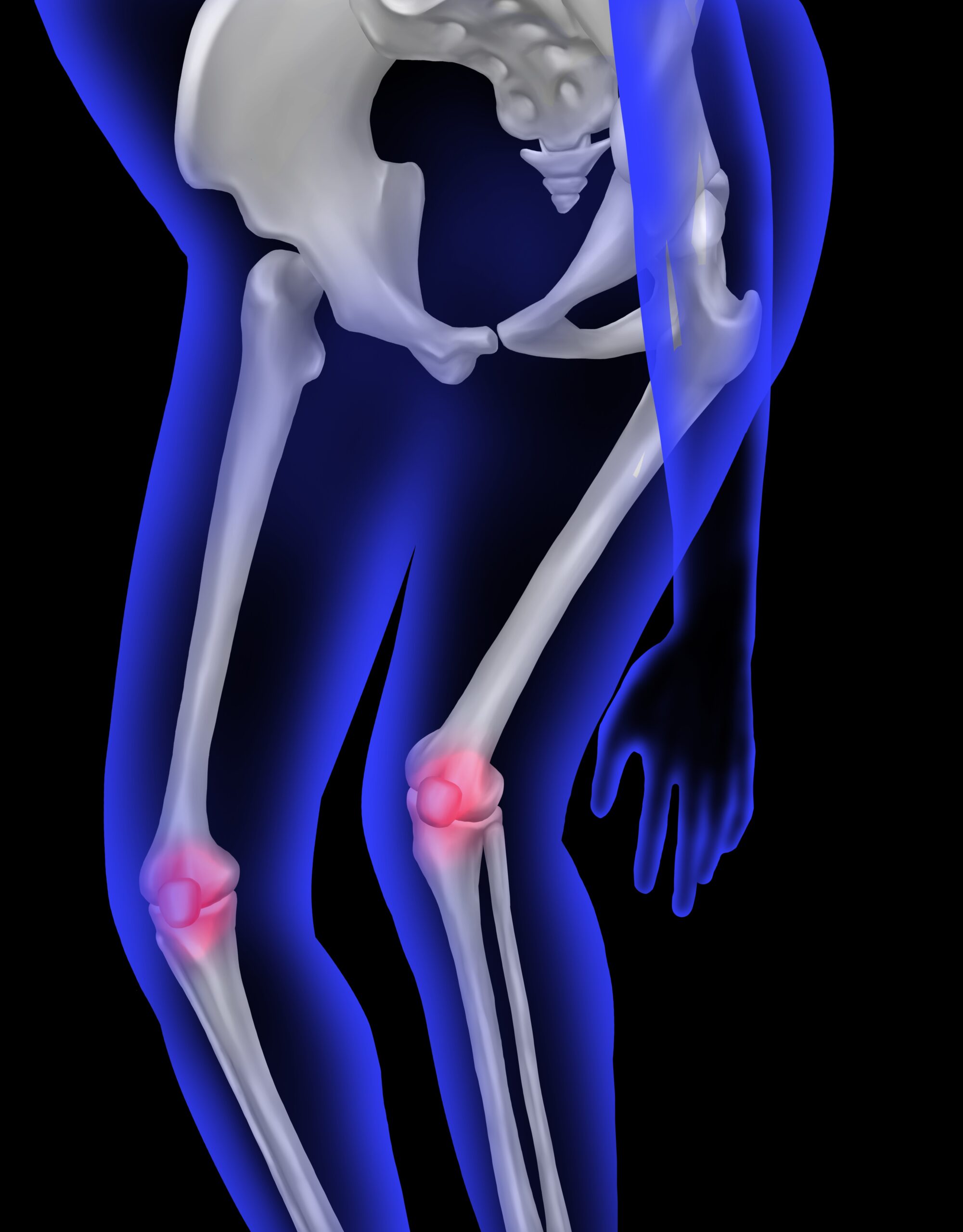 3D medical illustration showing the pelvis, hip, femur, and knee bones with red highlights at the knee joints indicating pain or inflammation.